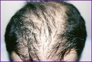 Before hair restoration
